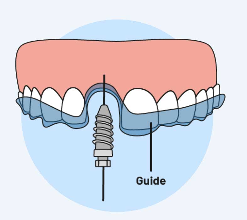 guided surgery 2 guided surgery