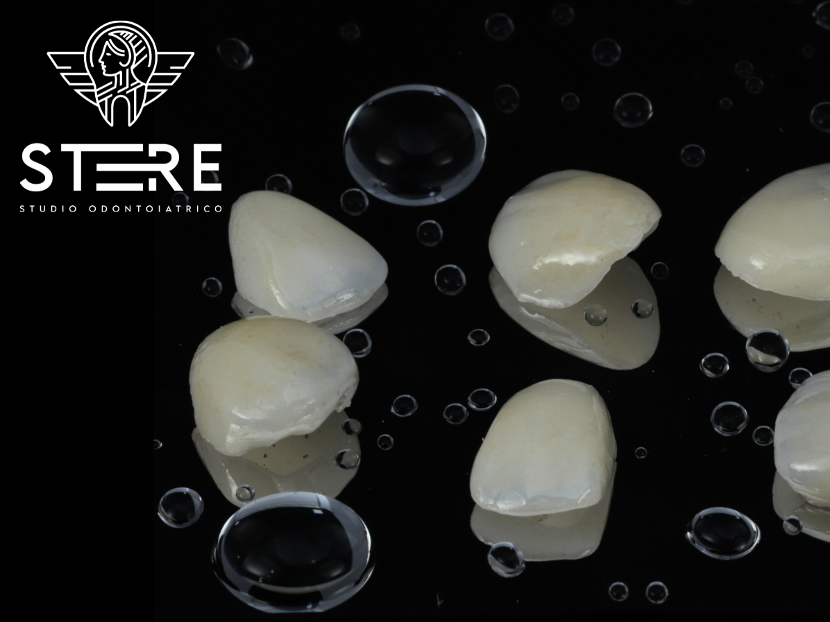 Image veneers dental veneers