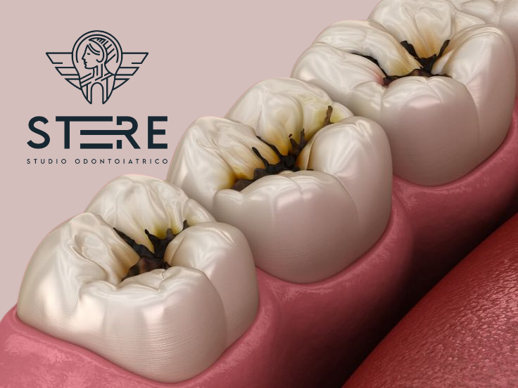 Carie image Dentistry Studio Stere Lecce