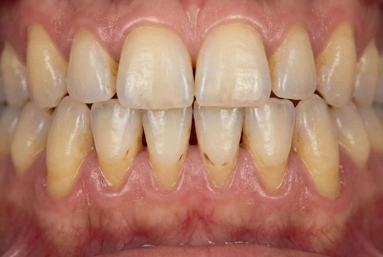 Fotografia clinica ravvicinata di denti con recessione gengivale visibile, smalto eroso nella zona cervicale e gengive ritirate che espongono le radici dentali, principale causa di sensibilità dentale trattata presso lo Studio Odontoiatrico Stere di Lecce