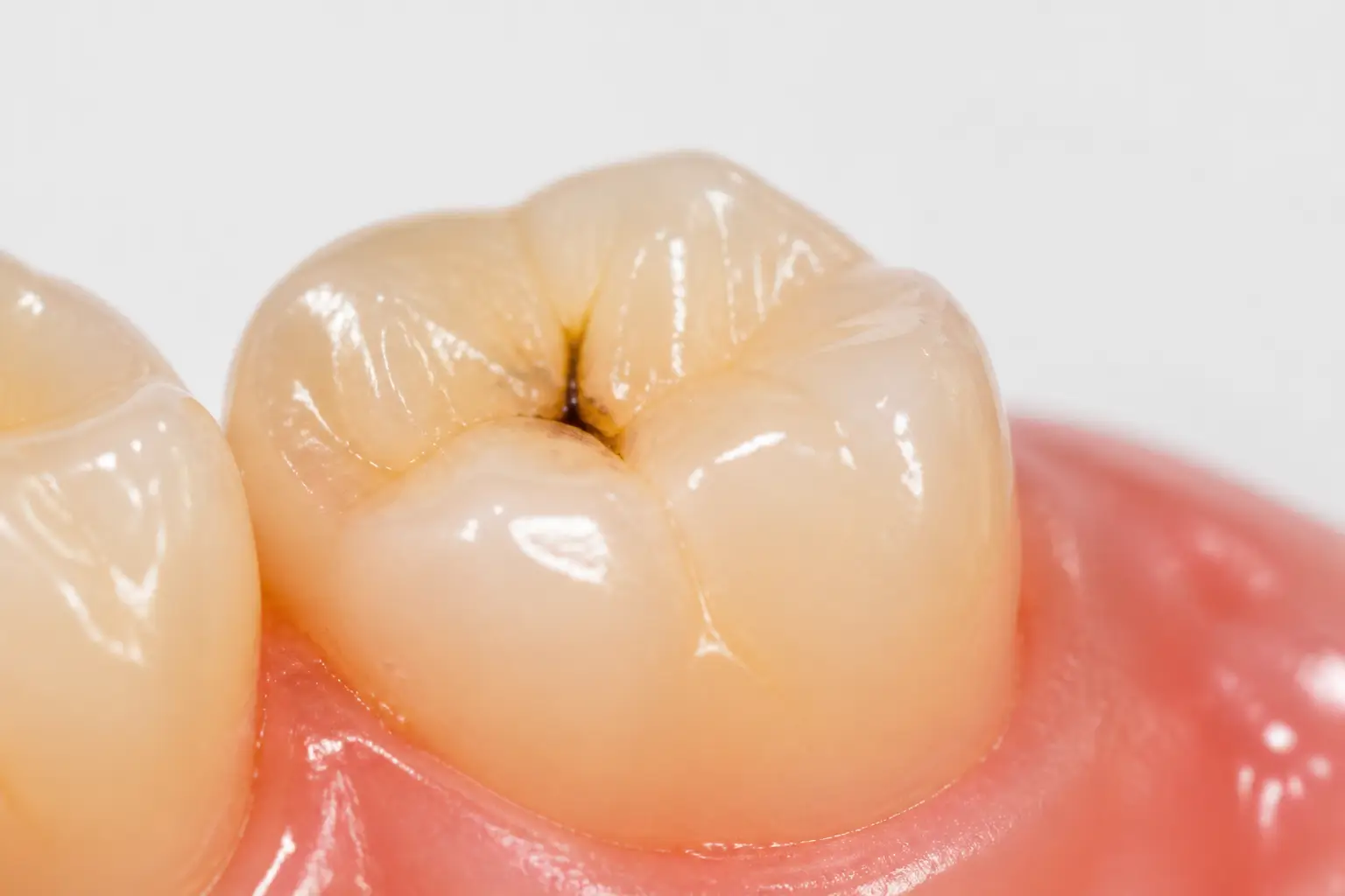 Foto reale di molare con carie iniziale visibile nei solchi occlusali, macchia scura sullo smalto dentale in stadio precoce — diagnosi e trattamento carie a Lecce presso lo Studio Odontoiatrico Stere, Via Giovanni Boccaccio 19 C/D/E, Salento, Puglia — studiostere.it