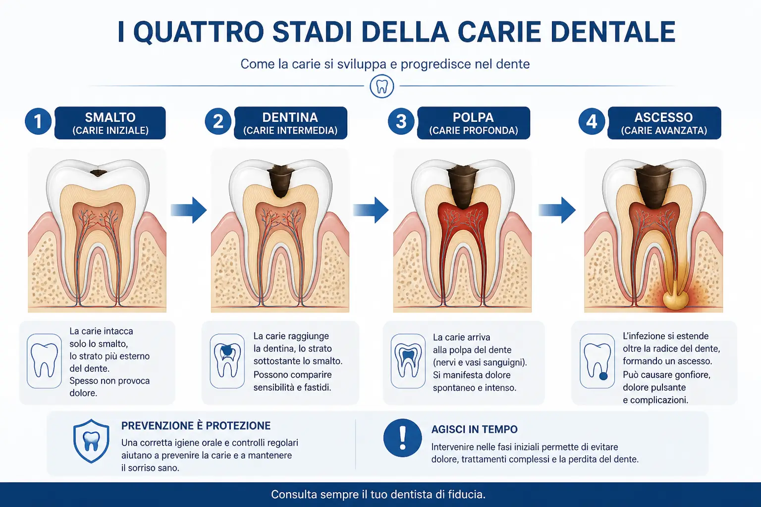 Infografica illustrata dei quattro stadi della carie dentale — carie iniziale dello smalto, carie intermedia della dentina, carie profonda della polpa e ascesso dentale — Studio Odontoiatrico Stere Lecce, Via Giovanni Boccaccio 19 C/D/E, Salento, Puglia — studiostere.it