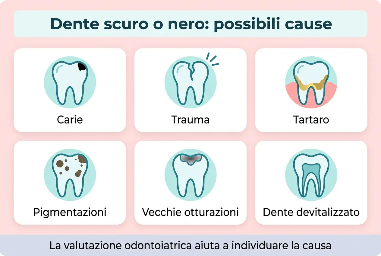 Infografica sulle possibili cause del dente scuro o nero, carie, trauma, tartaro, pigmentazioni, vecchie otturazioni e dente devitalizzato - Studio Odontoiatrico Stere