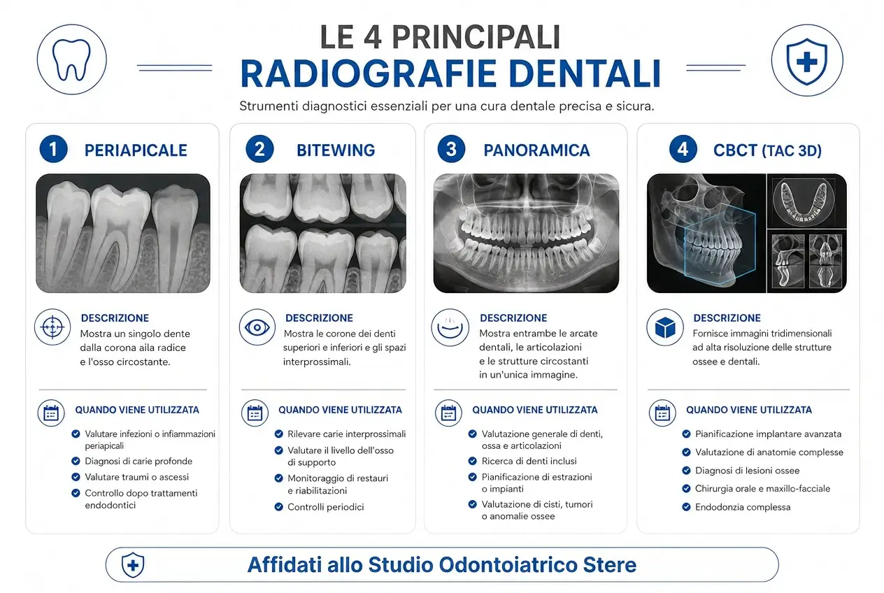 Infografica delle quattro principali tipologie di radiografia dentale: periapicale per infezioni e carie profonde, bitewing per carie interprossimali, panoramica per valutazione generale delle arcate, CBCT per pianificazione implantare avanzata. Diagnostica radiografica dentale a Lecce, Salento e Puglia — Studio Odontoiatrico Stere, Via Giovanni Boccaccio 19 C/D/E — Dott. Nicolò Stefanelli e Dott.ssa Rosanna Renò — studiostere.it