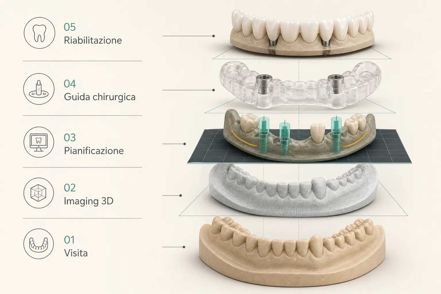 Infographics on the implant path with visit, 3D imaging, digital planning, surgical guidance and prosthetic rehabilitation - Studio Stere Lecce