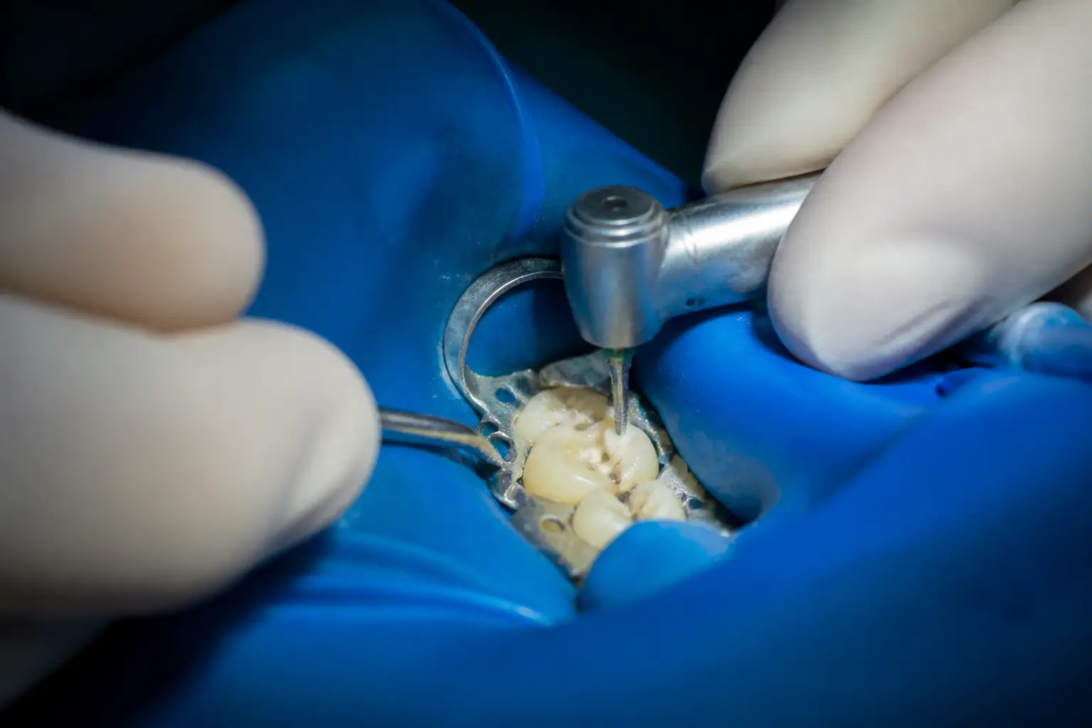 Primo piano del trattamento della carie dentale a Lecce: dentista con guanti rimuove il tessuto cariato mediante strumentazione rotante di precisione su molare isolato con diga di gomma. Come viene trattata la carie dentale a Lecce? Con rimozione conservativa del tessuto danneggiato e restauro in composito estetico, presso lo Studio Odontoiatrico Stere, Via Giovanni Boccaccio 19 C/D/E, Lecce, Salento, Puglia — studiostere.it