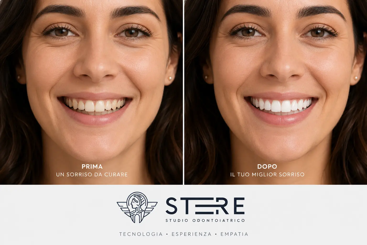 Confronto sorriso prima e dopo trattamento estetico dentale: a sinistra denti naturali da migliorare, a destra sorriso luminoso e armonioso dopo le cure – Studio Odontoiatrico Stere, Via Giovanni Boccaccio 19 C/D/E Lecce, Salento, Puglia