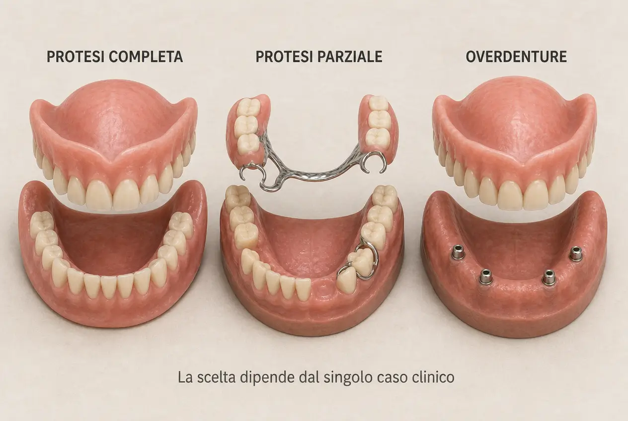Esempi di protesi dentali completa, protesi parziale rimovibile e overdenture su impianti per illustrare diverse soluzioni di riabilitazione protesica.