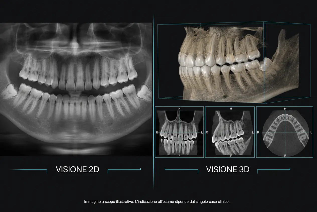 Confronto dello Studio Odontoiatrico Stere tra radiografia panoramica dentale in visione 2D e ricostruzione CBCT tridimensionale di denti e strutture ossee.
